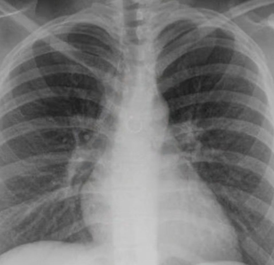 Woman’s Nose Ring Found Inside Her Lung